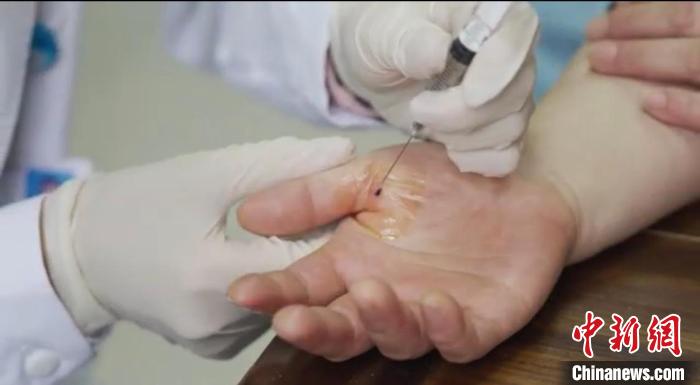 嘉善群眾體驗小針刀?！〖紊平y(tǒng)戰(zhàn) 供圖