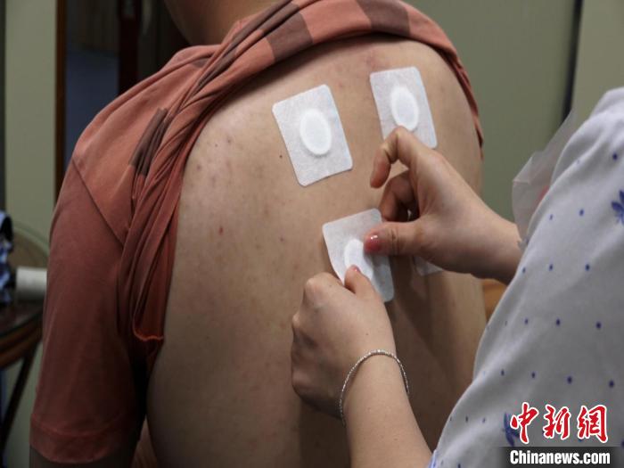 圖為醫(yī)生正在為民眾貼“三伏貼”。　唐蔚晴 攝